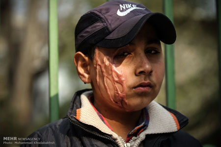ماجرای اسیدپاشی به علی اکبر 11 ساله