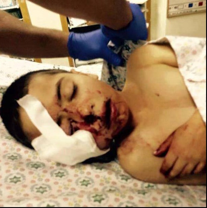 اصابت‌ گلوله اسرائیلی بر صورت یک کودک+عکس