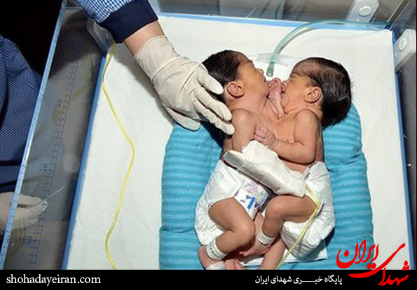 تصاویر/تولد دوقلو های به هم چشبیده در شیراز