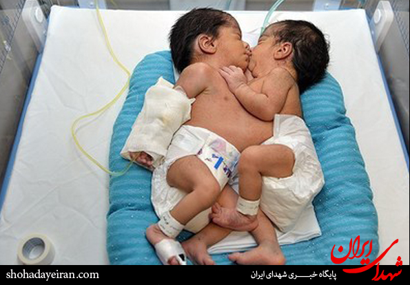تصاویر/تولد دوقلو های به هم چشبیده در شیراز