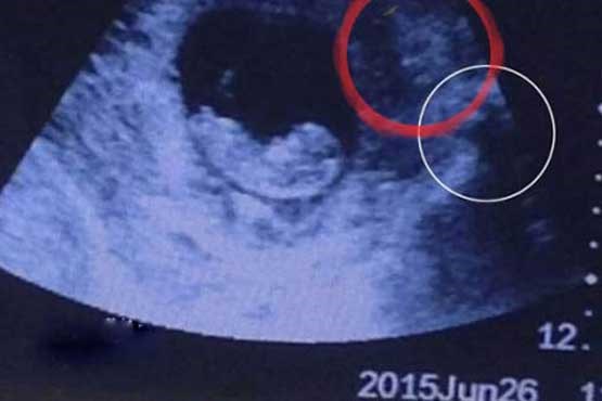 تصویری عجیب شبیه شیطان در شکم زن باردار+عکس