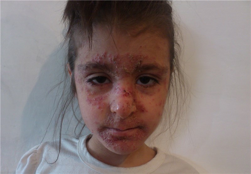 خانه‌نشینی دختربچه ۷ ساله بر اثر بیماری+عکس