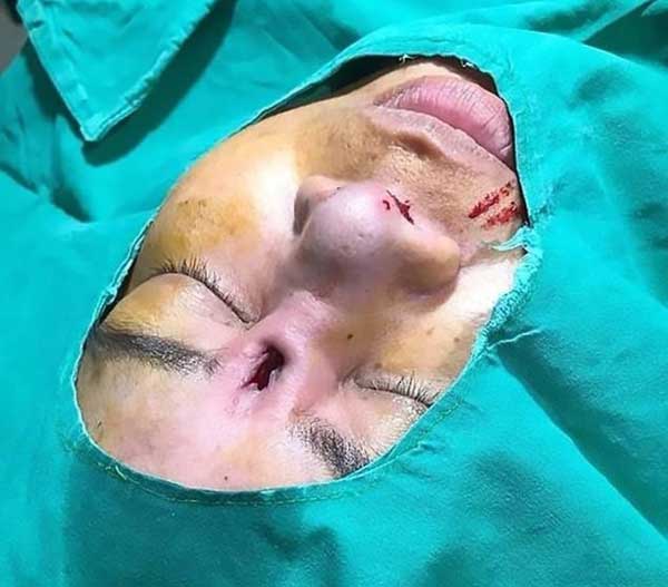 عاقبت وحشتناک جراحی بینی در یک کلینیک +عکس