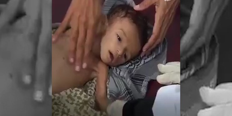 سازمان ملل:هر 12 دقیقه، یک کودک زیر 5 سال در یمن جان می‌بازد