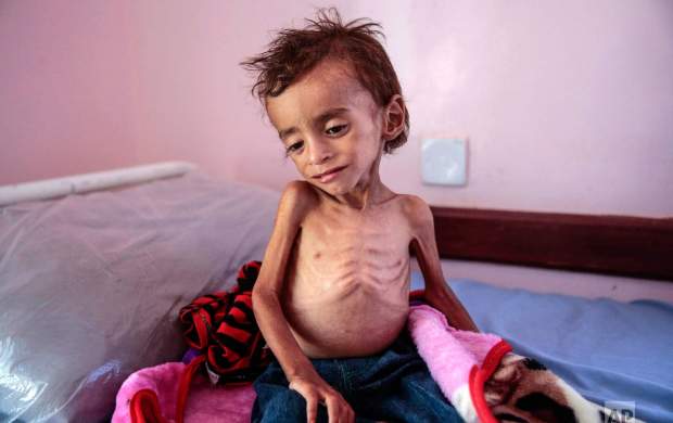 ۴۰۰ هزار کودک زیر ۵ سال یمنی در آستانه مرگ از گرسنگی