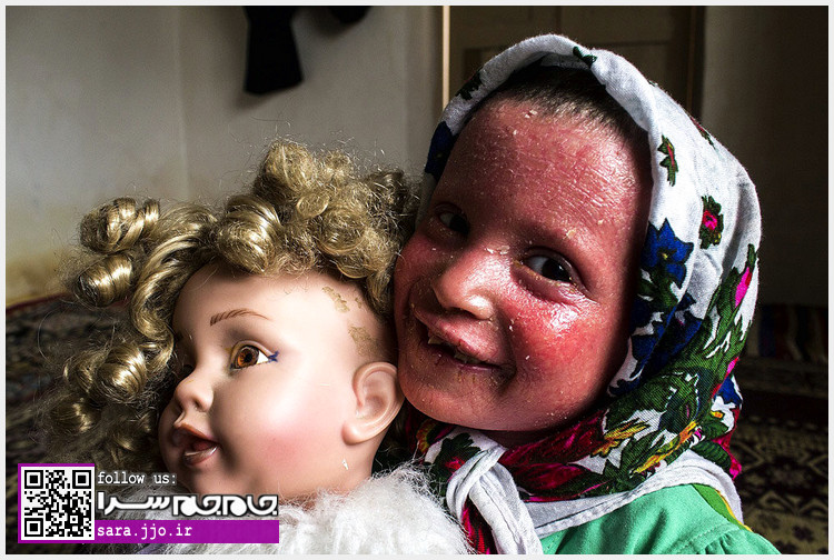 دختر بچه‌ای با یک بیماری پوستی دردآور + تصاویر