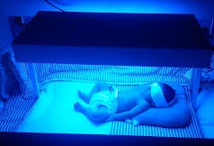 نوزاد ۳ روزه در دستگاه فتوتراپی سوخت +عکس