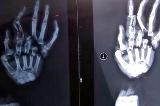 مرد بی‌رحم دست زنش را با ساطور خرد کرد!+عکس