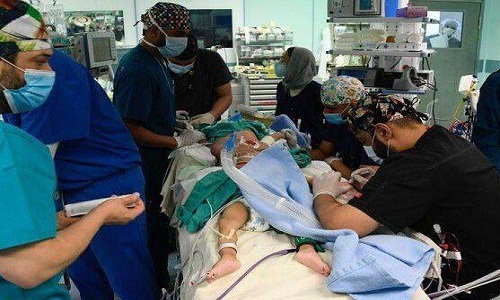 جداسازی دوقلوهای یمنی پس از ۱۵ ساعت عمل جراحی+عکس