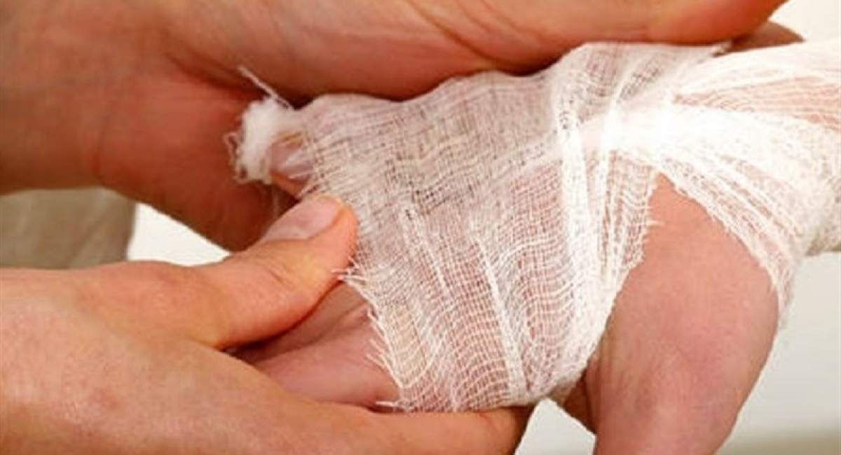 بستری سالانه ۳۰ هزار نفر بر اثر سوختگی